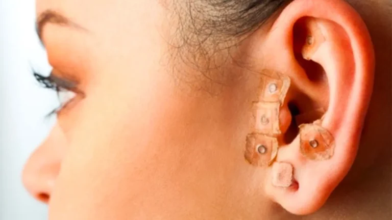 o que é auriculoterapia